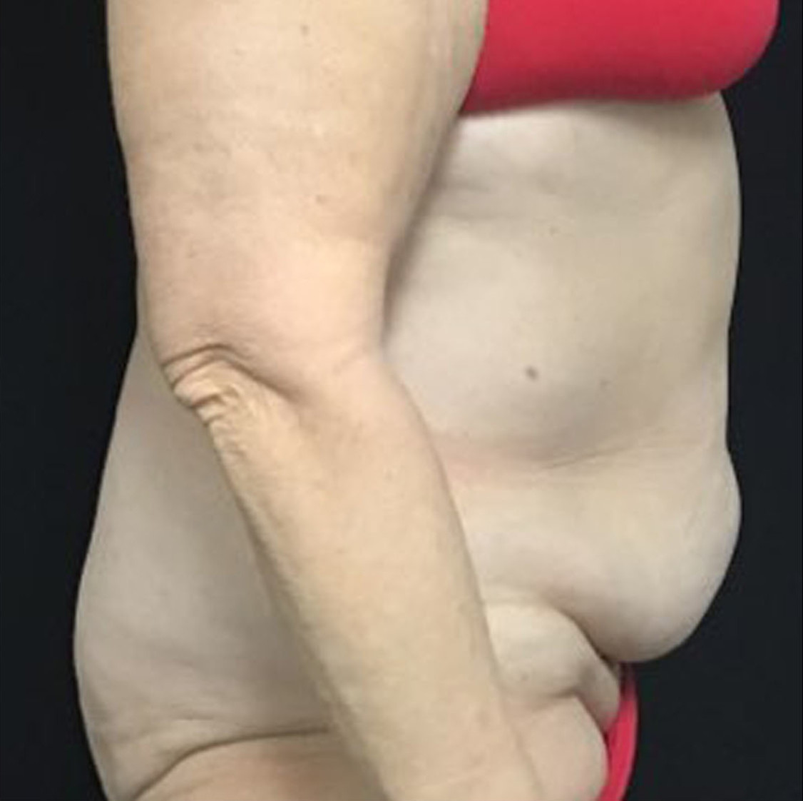 Liposuction Patient Photo - Case 3469 - before view-2