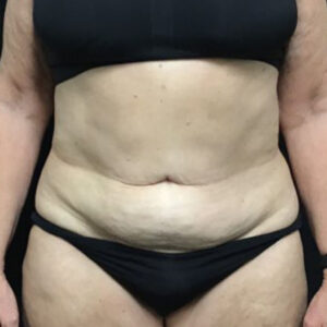 Liposuction - Case 3469 - After