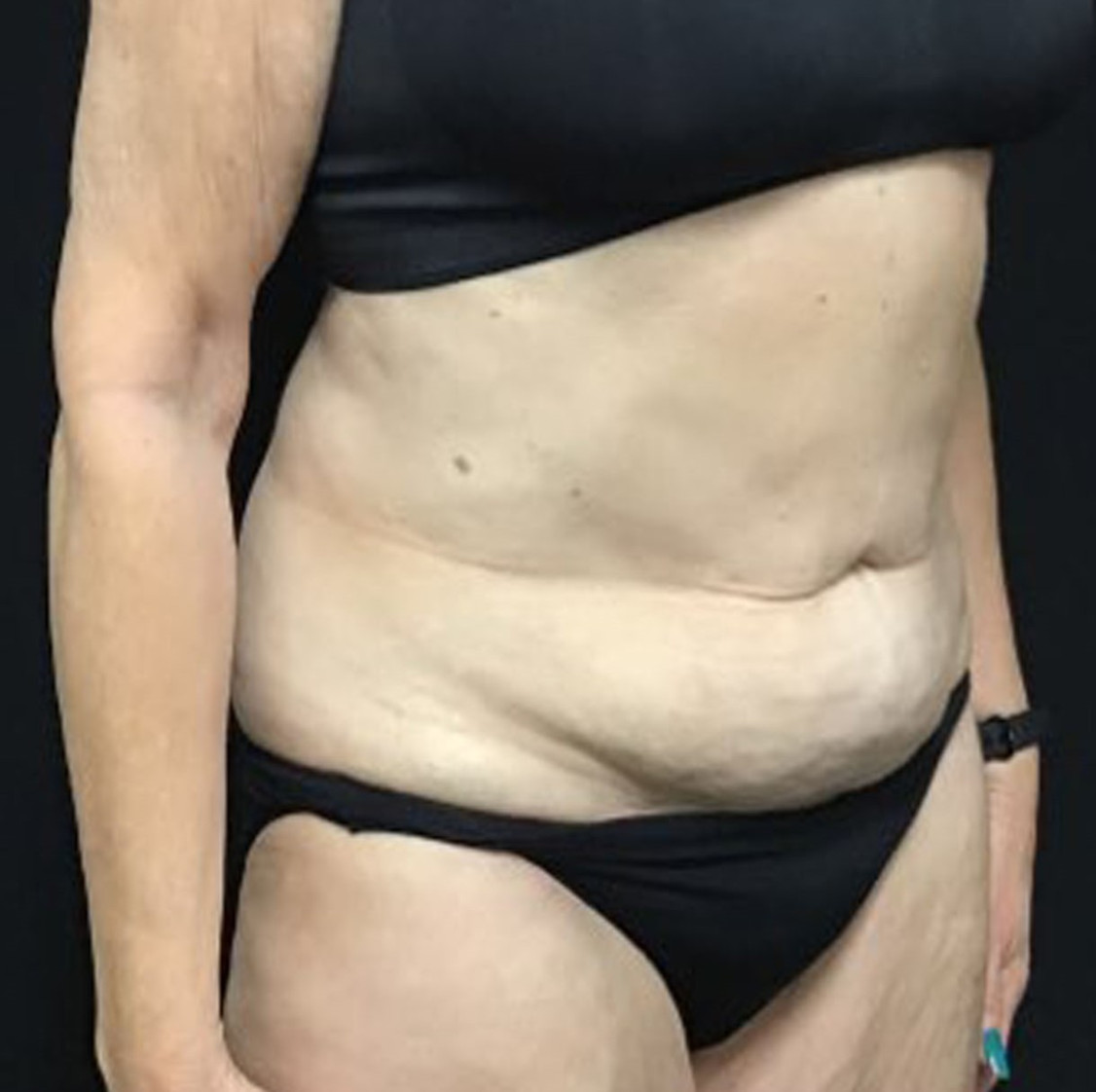 Liposuction Patient Photo - Case 3469 - after view-1