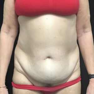 Liposuction - Case 3469 - Before