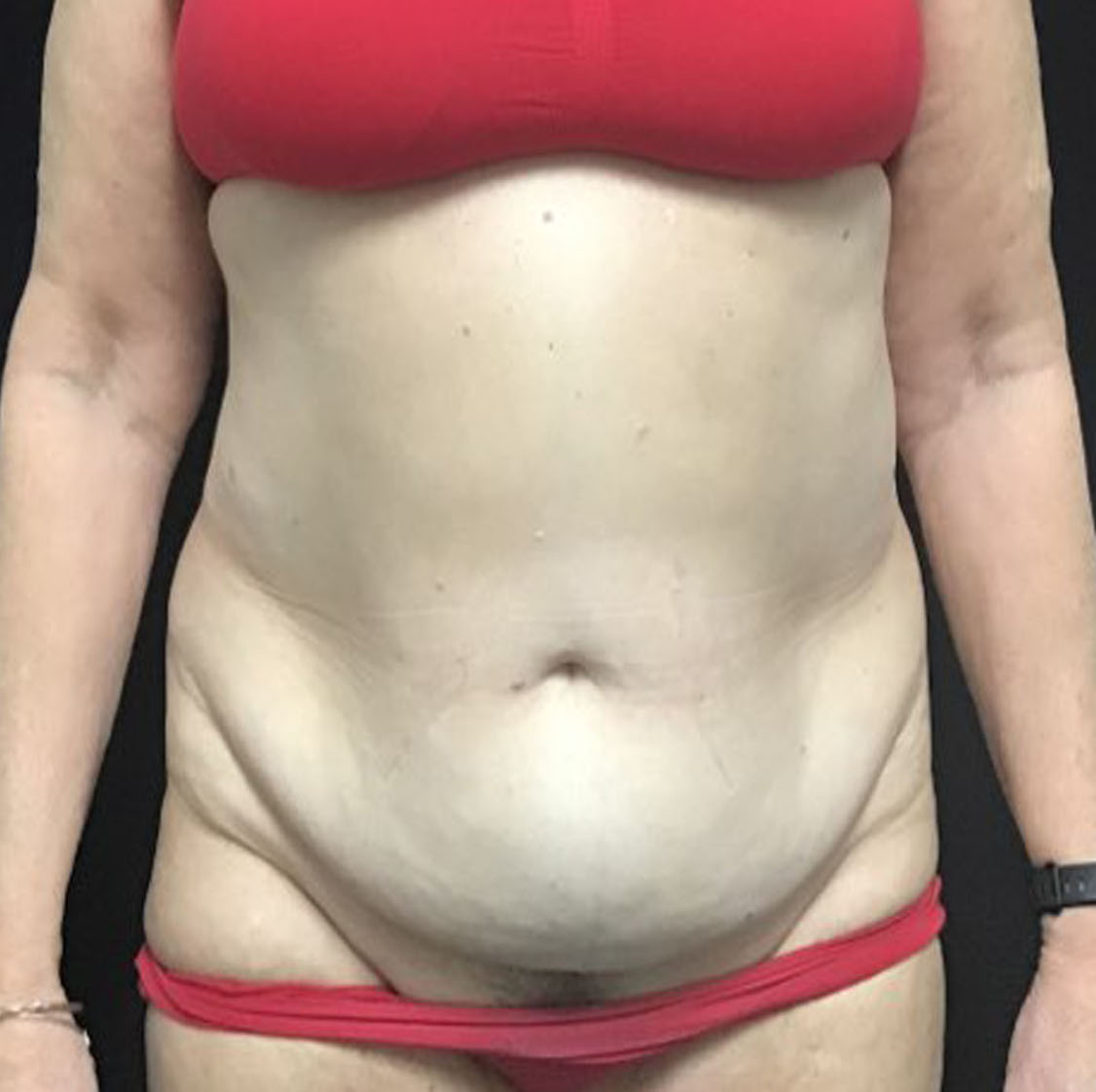 Liposuction Patient Photo - Case 3469 - before view-0