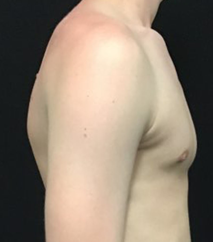 Gynecomastia Patient Photo - Case 3473 - after view