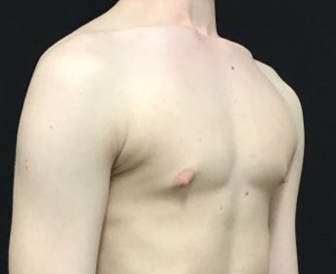 Gynecomastia Patient Photo - Case 3473 - before view-1