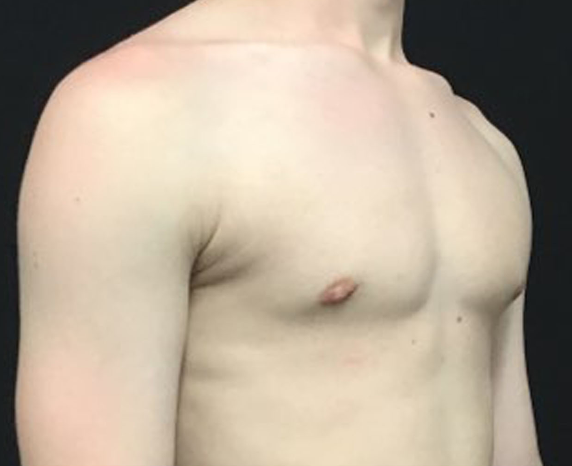 Gynecomastia Patient Photo - Case 3473 - after view-1
