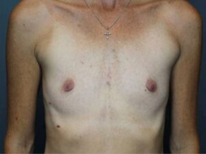 Breast Augmentation - Case 3692 - Before
