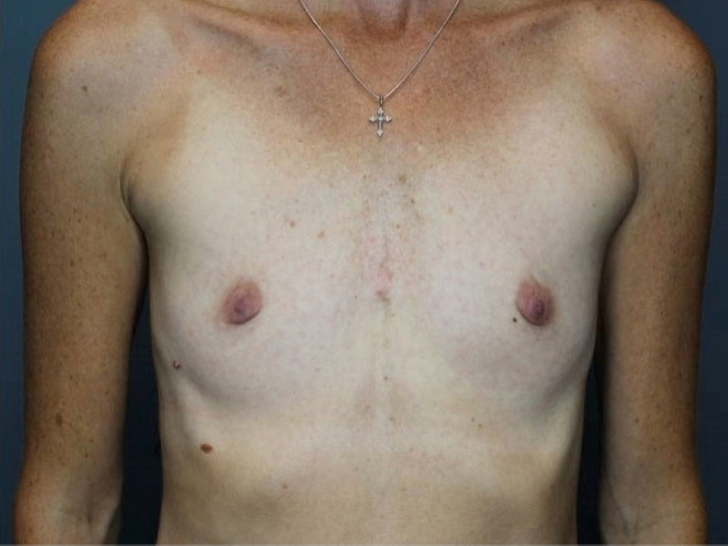 Breast Augmentation Patient Photo - Case 3692 - before view-0
