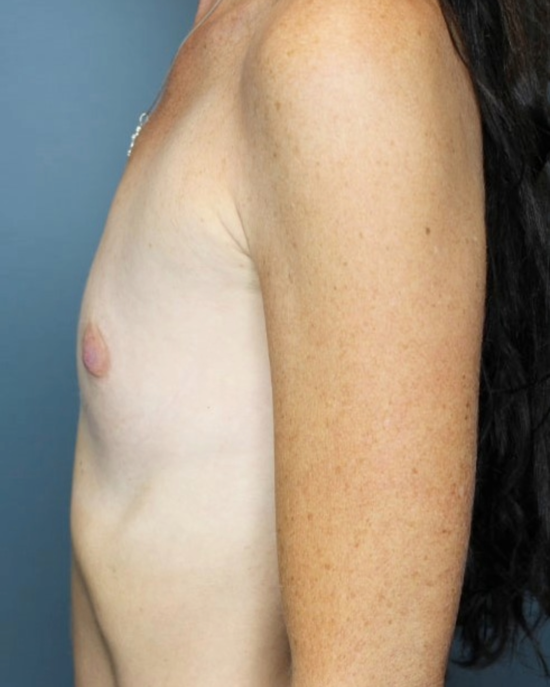 Breast Augmentation Patient Photo - Case 3692 - before view-1