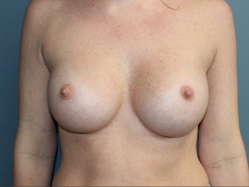 Breast Augmentation Patient Photo - Case 3698 - after view-0