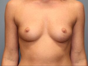Breast Augmentation - Case 3698 - Before