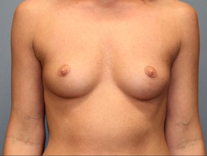 Breast Augmentation Patient Photo - Case 3698 - before view-0