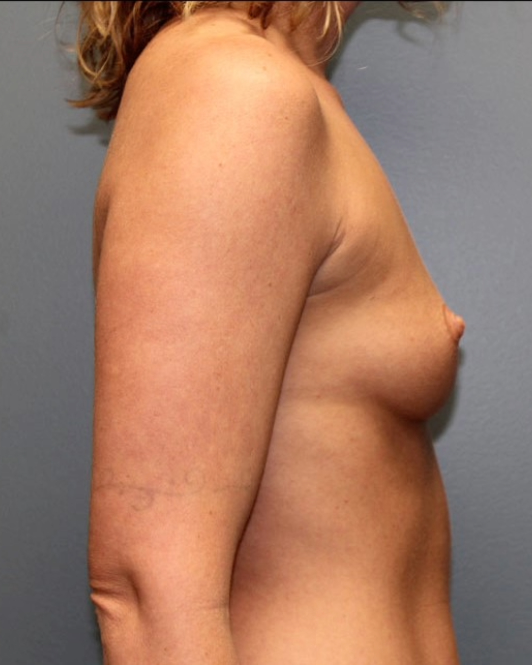 Breast Augmentation Patient Photo - Case 3698 - before view-1