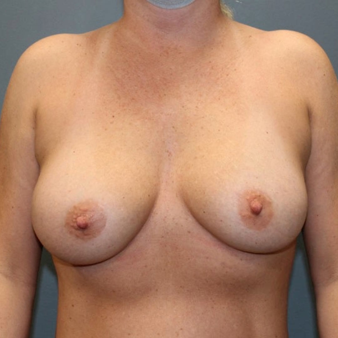 Breast Augmentation Patient Photo - Case 3707 - after view