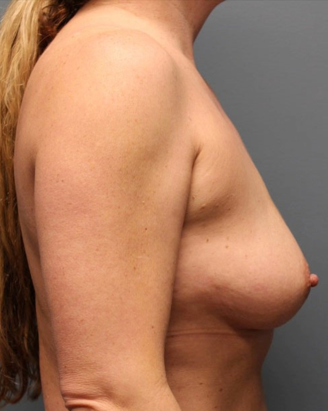 Breast Augmentation Patient Photo - Case 3707 - before view-1