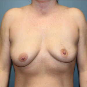 Breast Augmentation - Case 3707 - Before