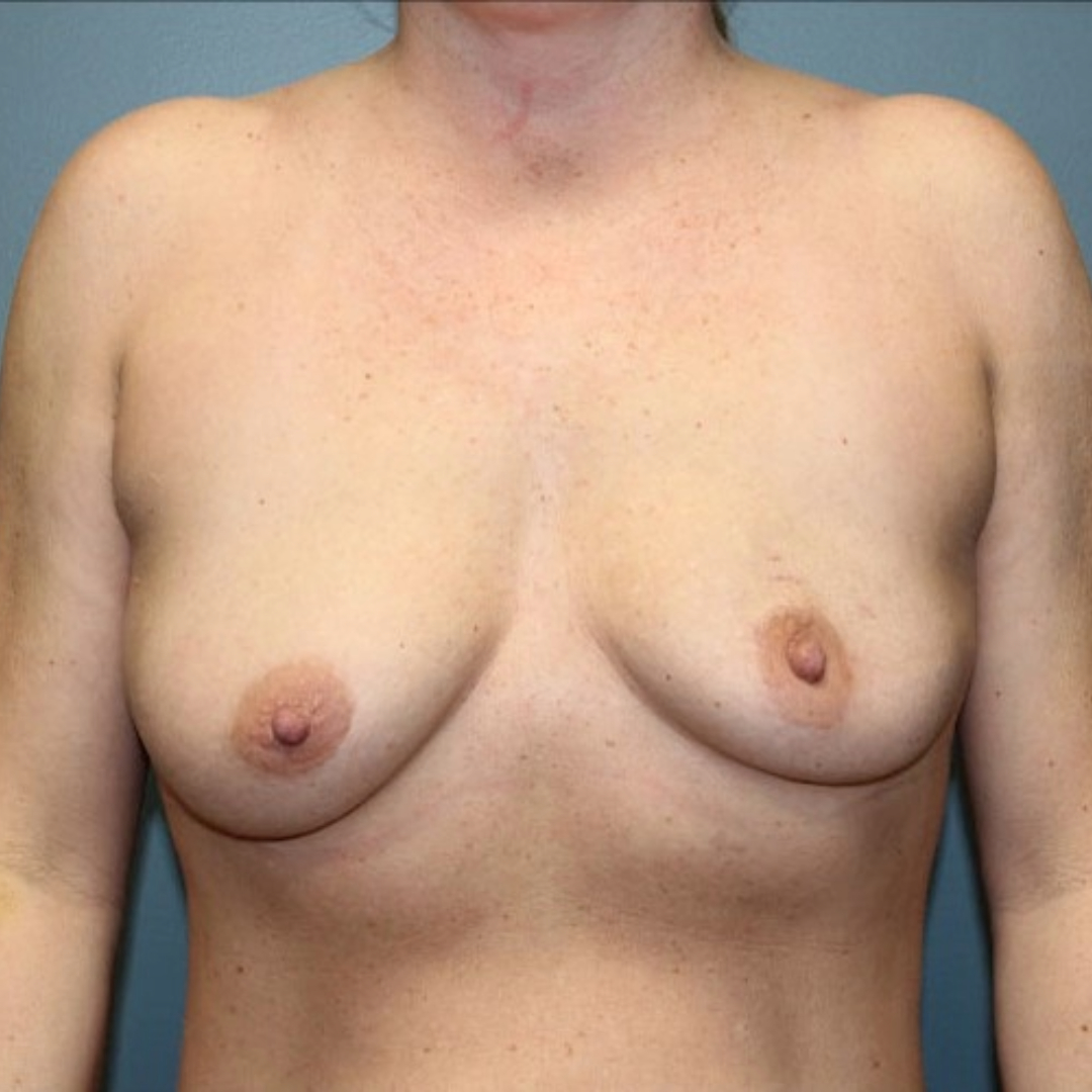 Breast Augmentation Patient Photo - Case 3707 - before view-0