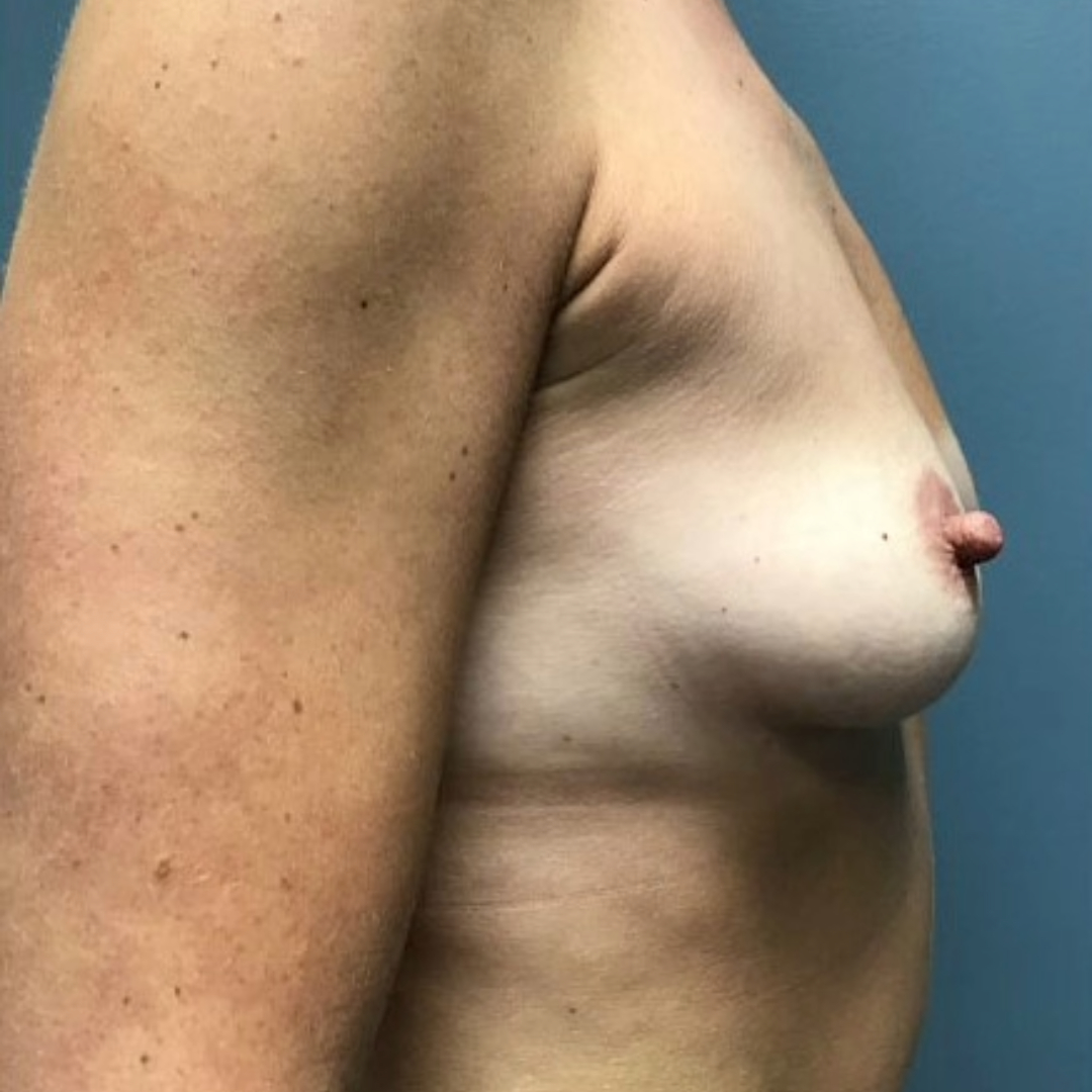 Breast Augmentation Patient Photo - Case 3714 - before view-1