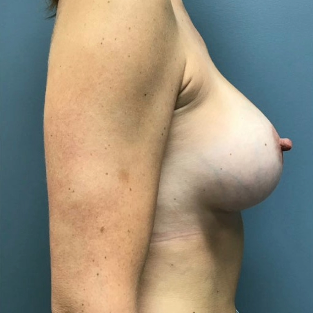 Breast Augmentation Patient Photo - Case 3714 - after view-1