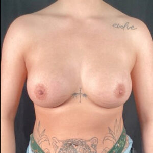 Breast Augmentation - Case 3726 - After