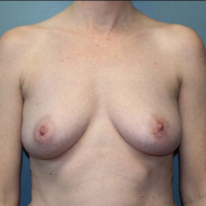 Breast Augmentation - Case 3733 - Before
