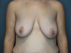 Breast Augmenation with Lift - Case 3745 - Before