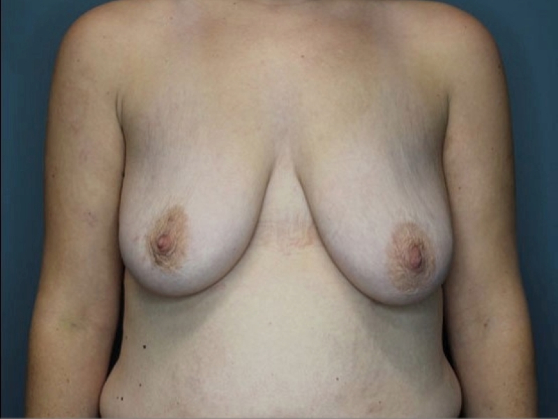 Breast Augmenation with Lift Patient Photo - Case 3745 - before view-0