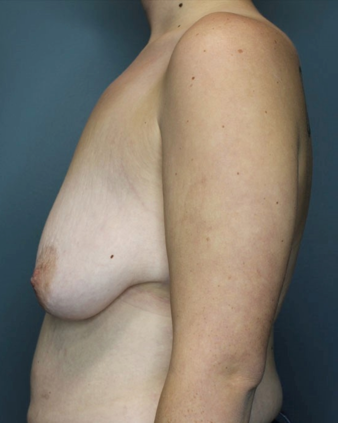 Breast Augmenation with Lift Patient Photo - Case 3745 - before view-2