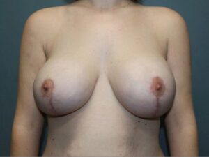 Breast Augmenation with Lift - Case 3745 - After