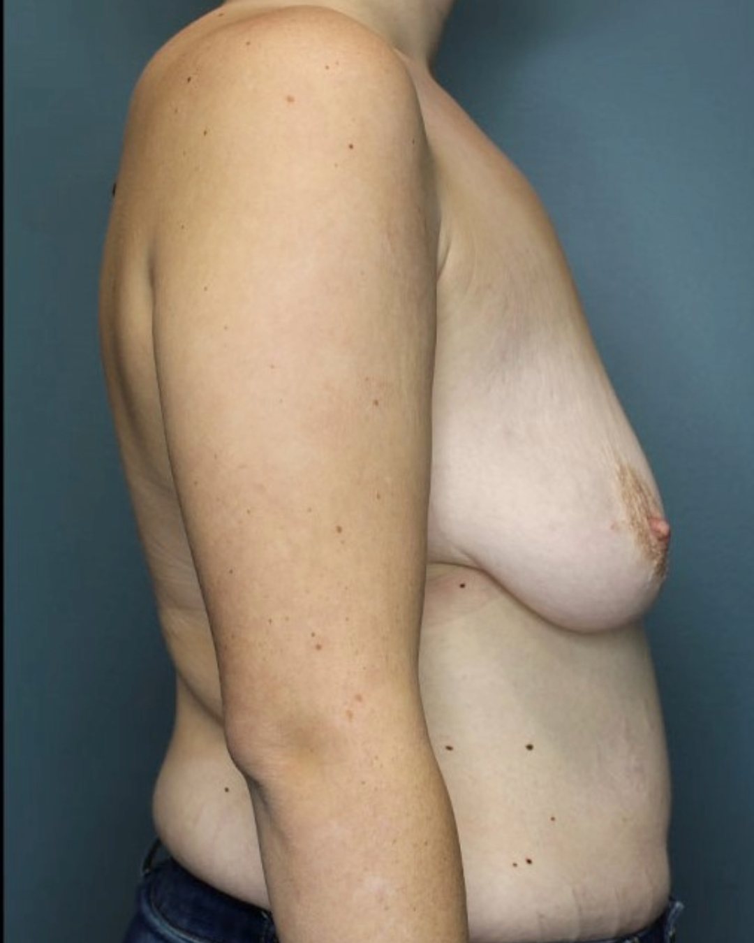 Breast Augmenation with Lift Patient Photo - Case 3745 - before view-1