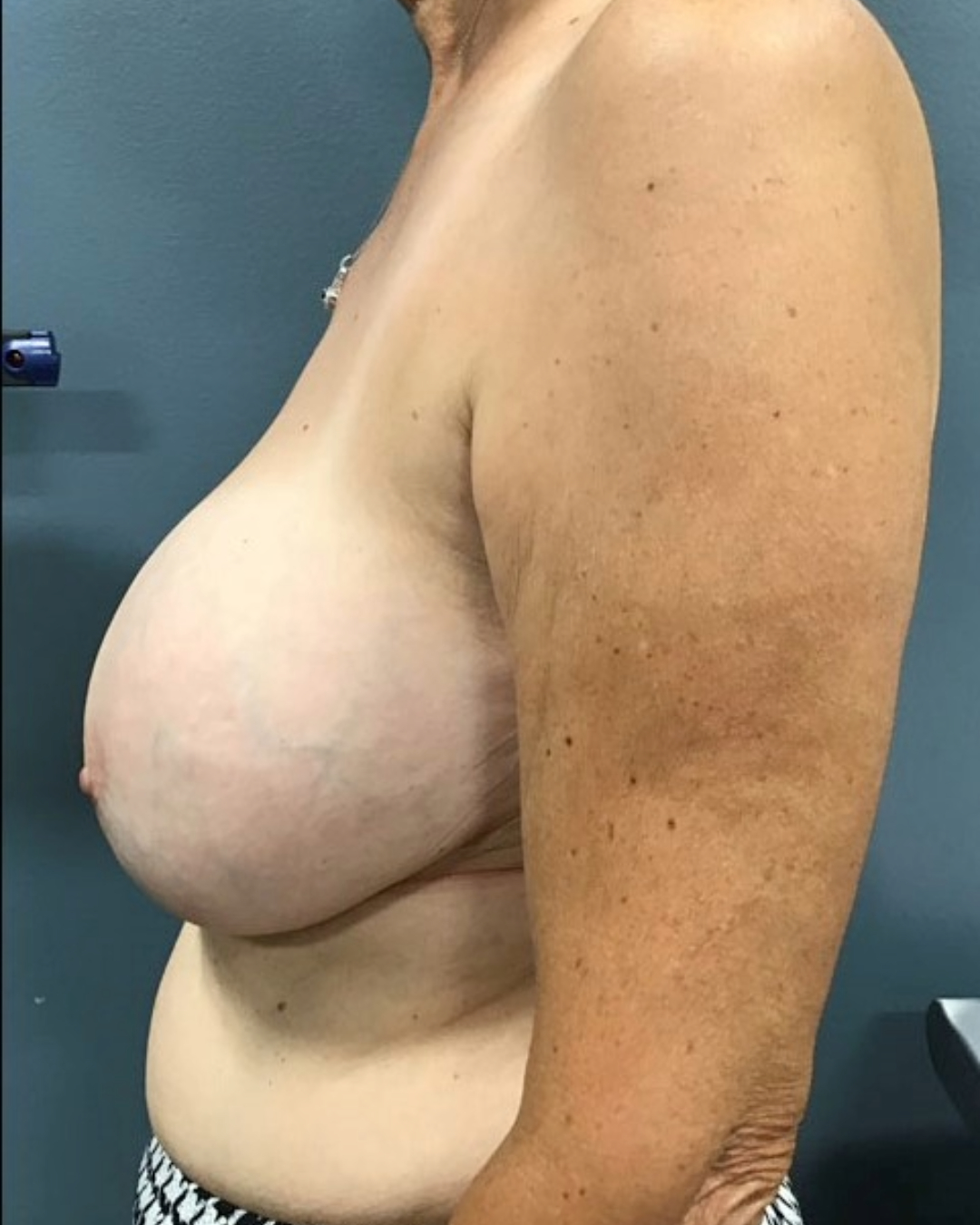 Breast Lift Patient Photo - Case 3758 - before view-2