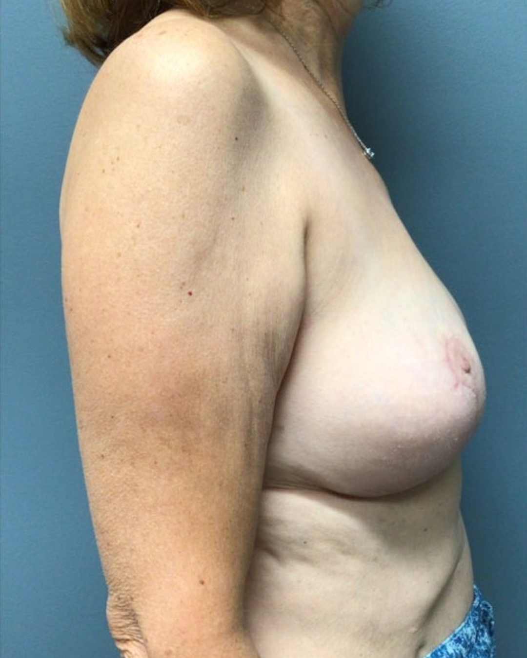 Breast Lift Patient Photo - Case 3758 - after view-1