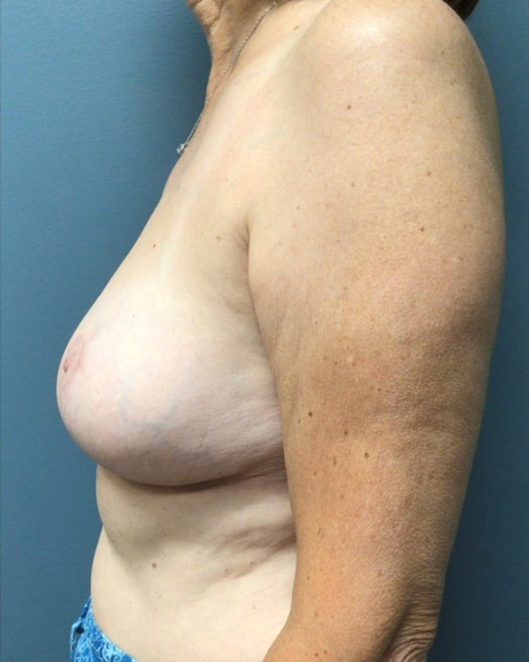 Breast Lift Patient Photo - Case 3758 - after view-2