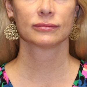 Evoke Facial Remodeling - Case 3767 - After