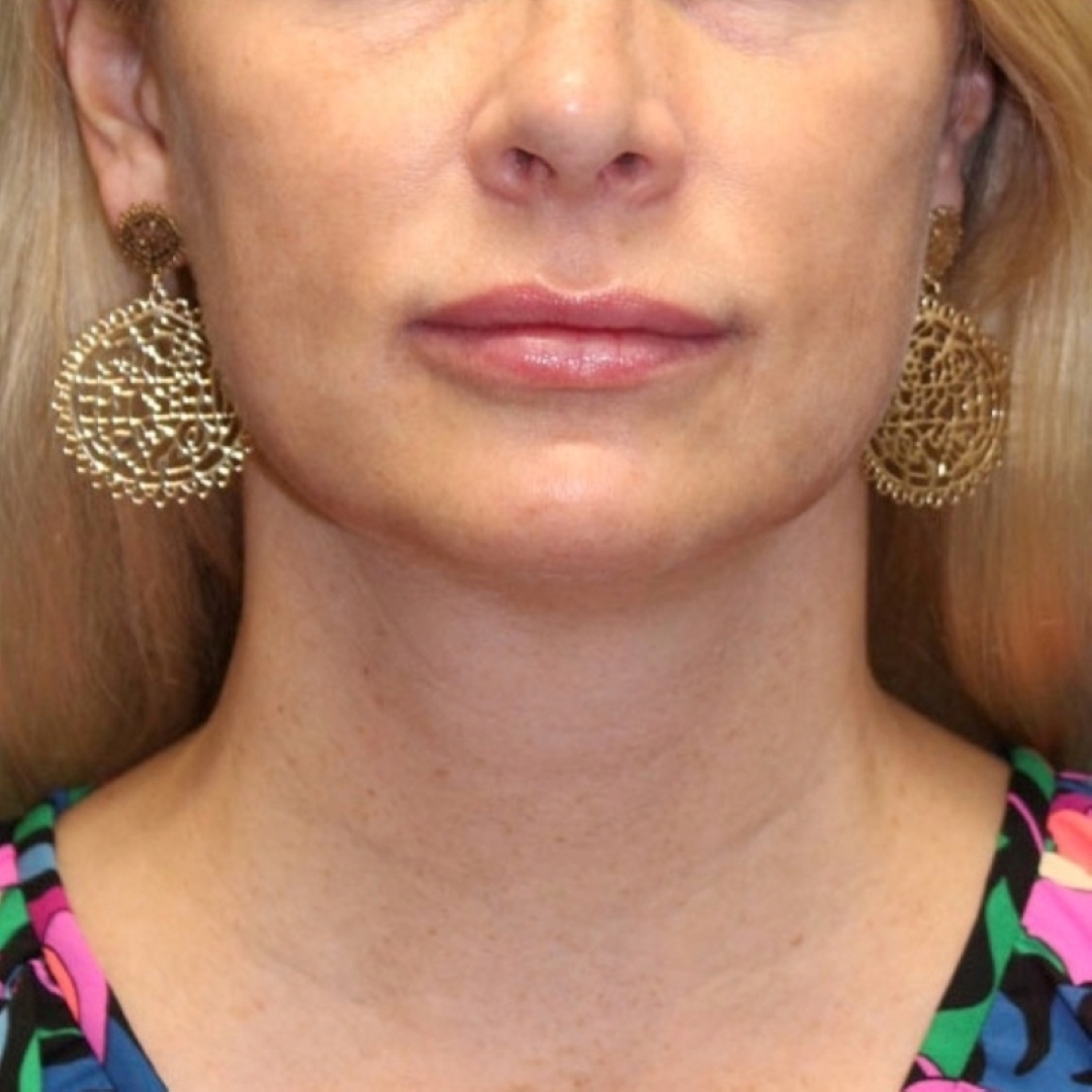 Evoke Facial Remodeling Patient Photo - Case 3767 - after view-0