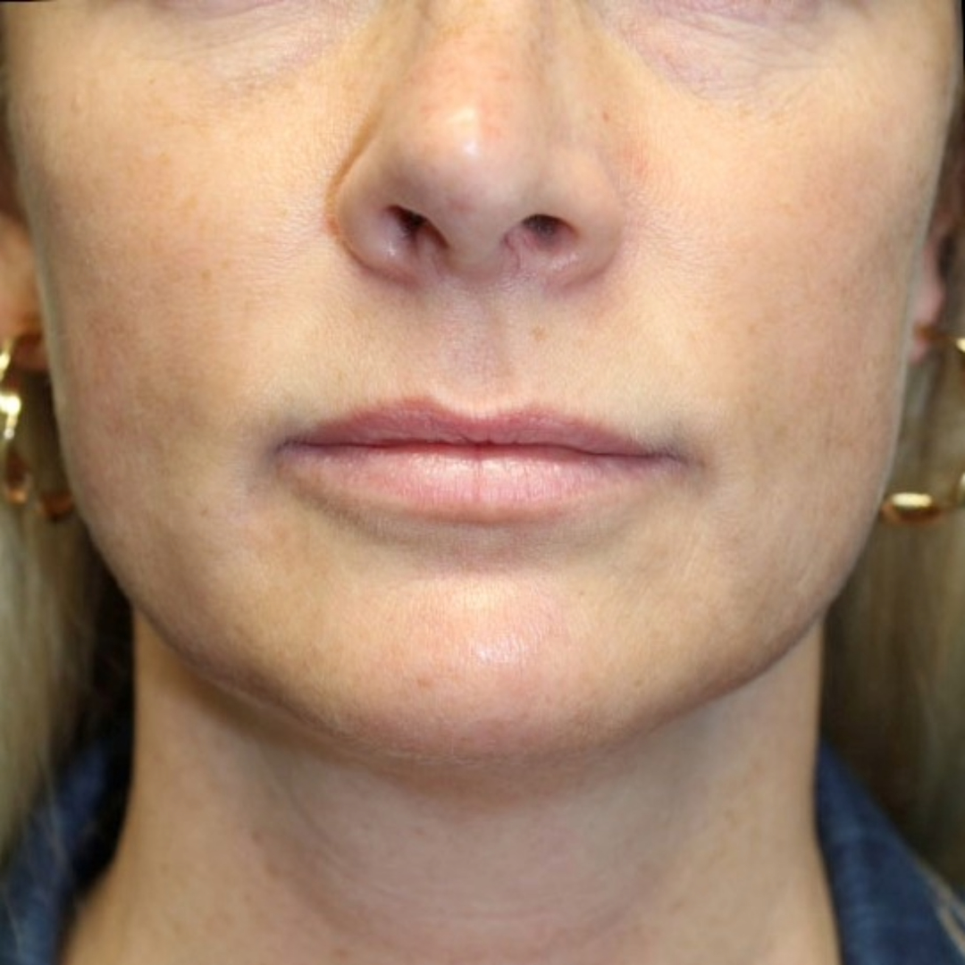 Evoke Facial Remodeling Patient Photo - Case 3767 - before view-