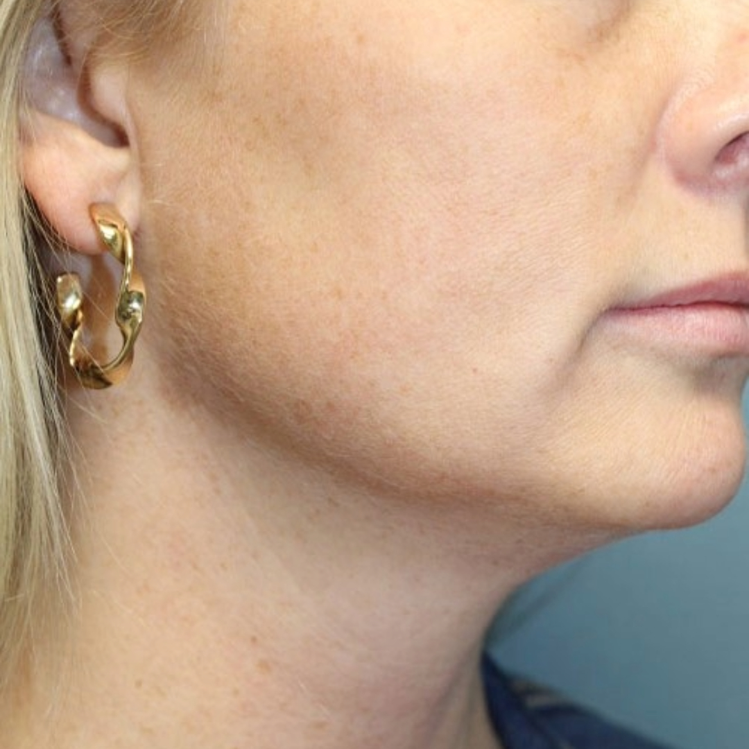 Evoke Facial Remodeling Patient Photo - Case 3767 - before view-1