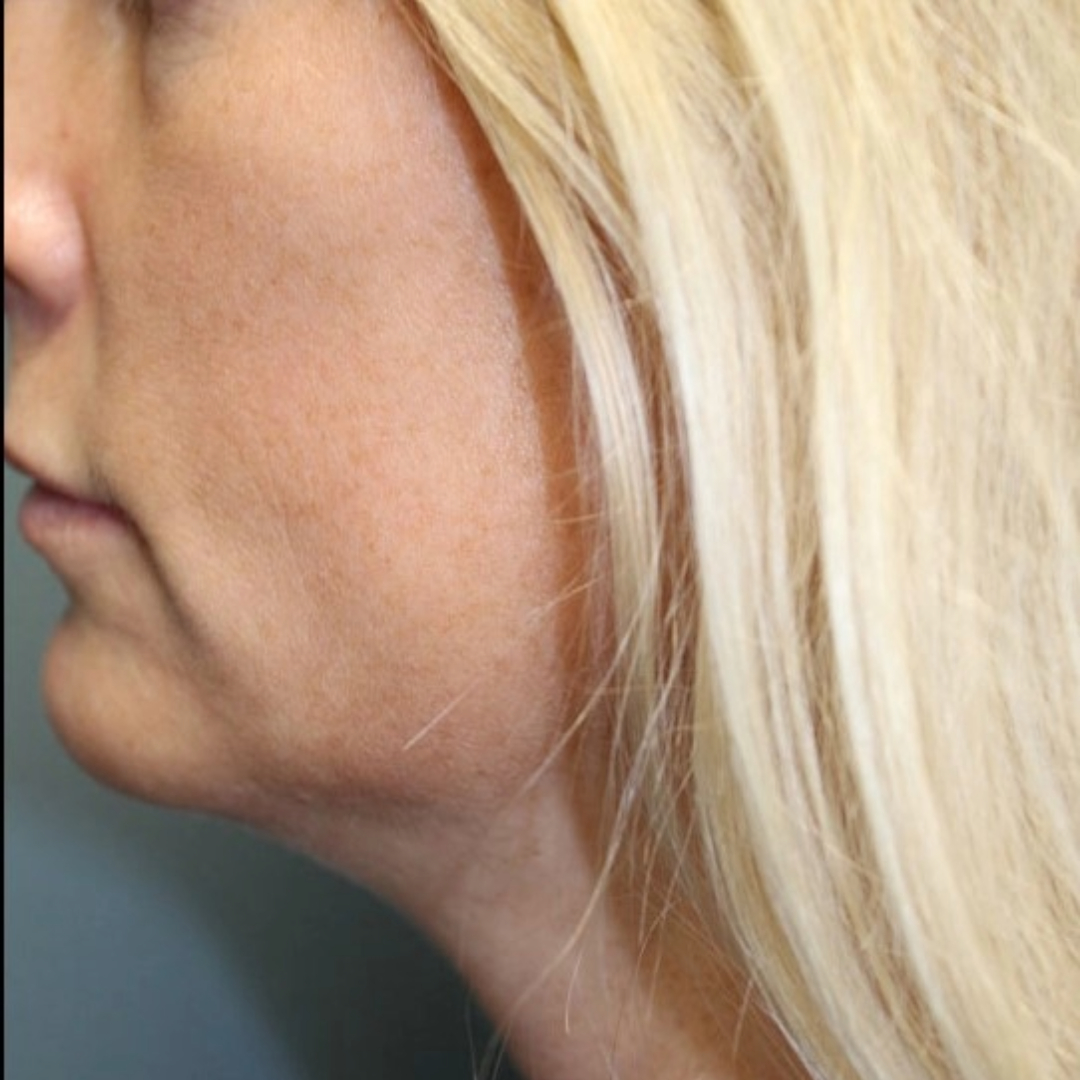 Evoke Facial Remodeling Patient Photo - Case 3767 - before view-2