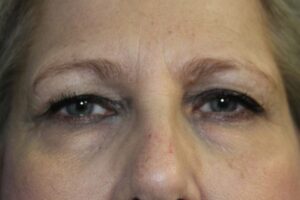 Eyelid Surgery - Case 3794 - Before