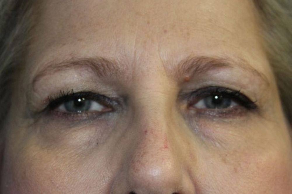 Eyelid Surgery Patient Photo - Case 3794 - before view-0