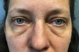 Eyelid Surgery - Case 3799 - Before