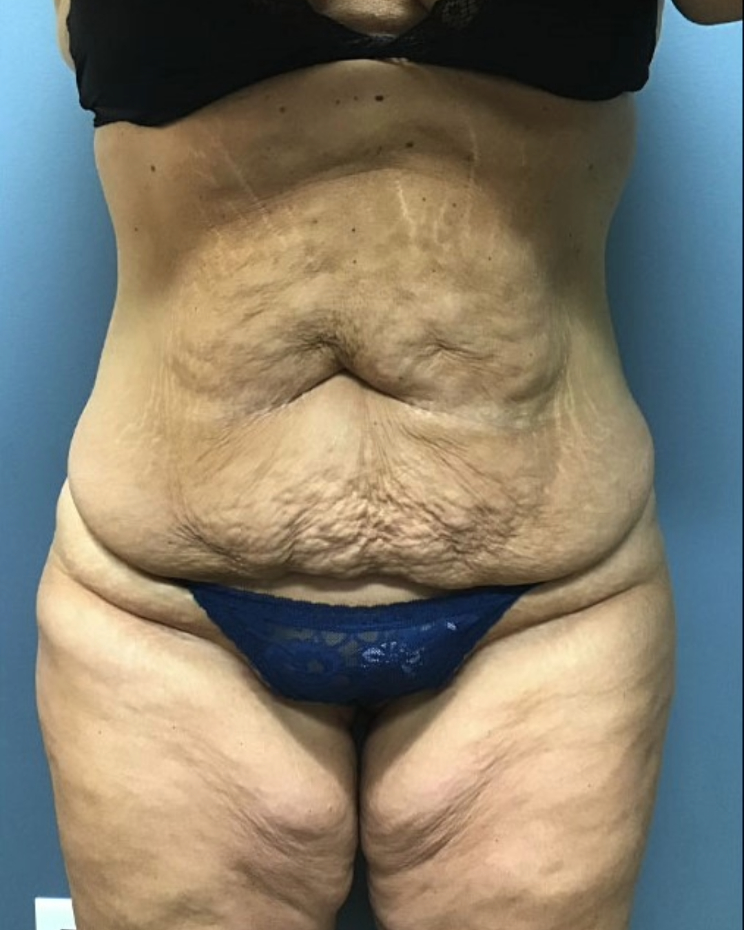 Tummy Tuck Patient Photo - Case 3803 - before view-0