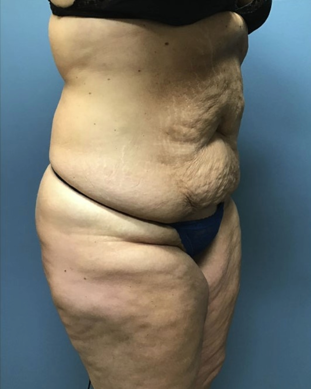 Tummy Tuck Patient Photo - Case 3803 - before view-1