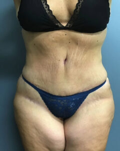Tummy Tuck - Case 3803 - After
