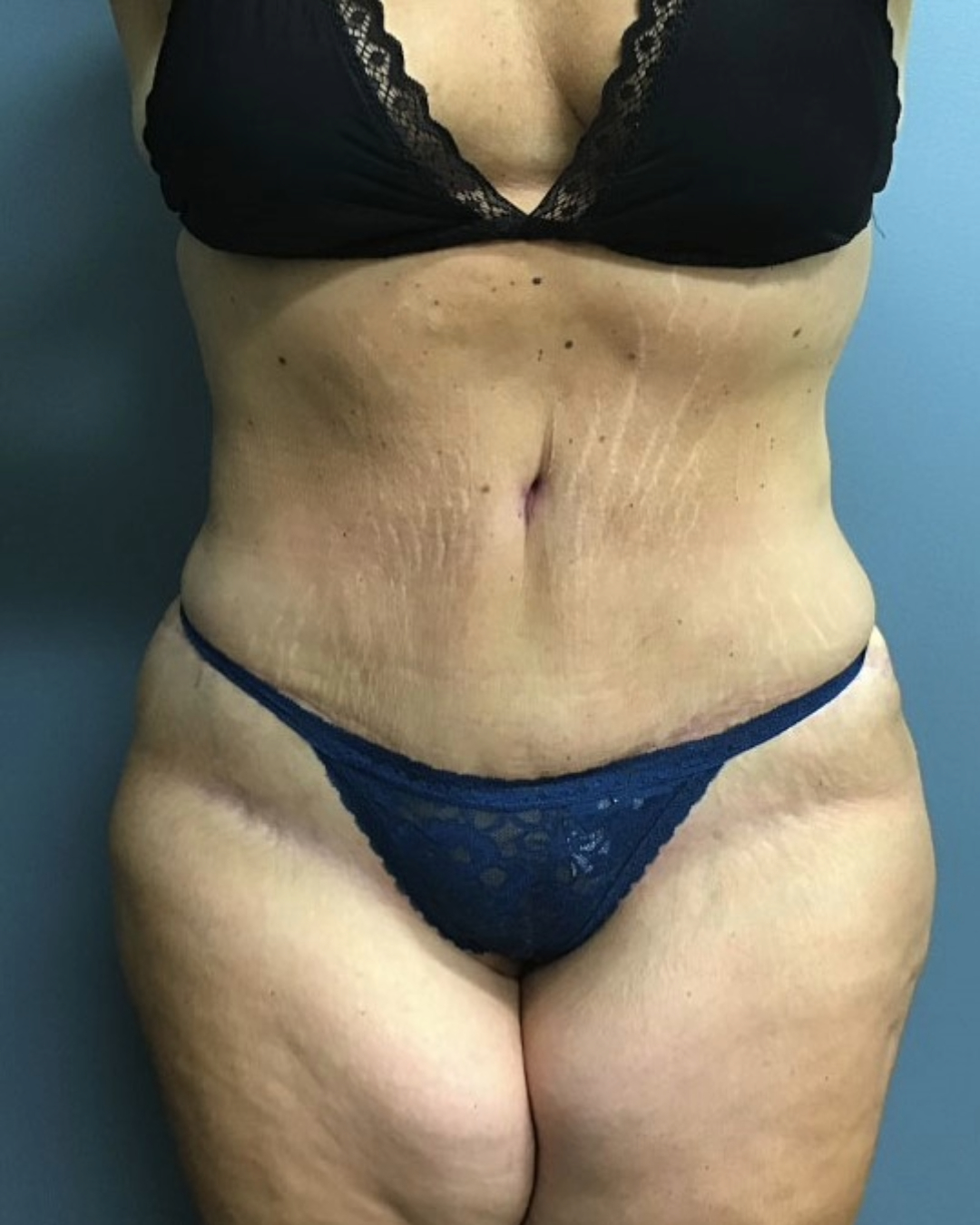 Tummy Tuck Patient Photo - Case 3803 - after view