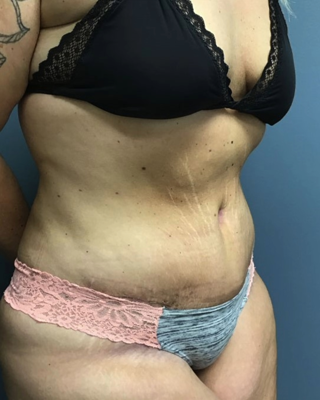 Tummy Tuck Patient Photo - Case 3803 - after view-1