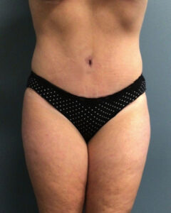 Tummy Tuck - Case 3808 - After