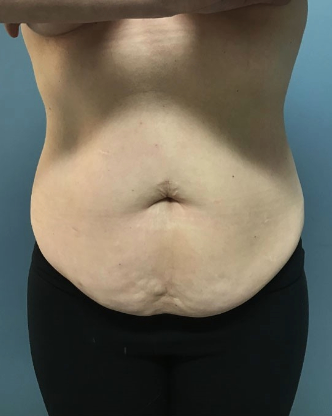 Tummy Tuck Patient Photo - Case 3808 - before view-