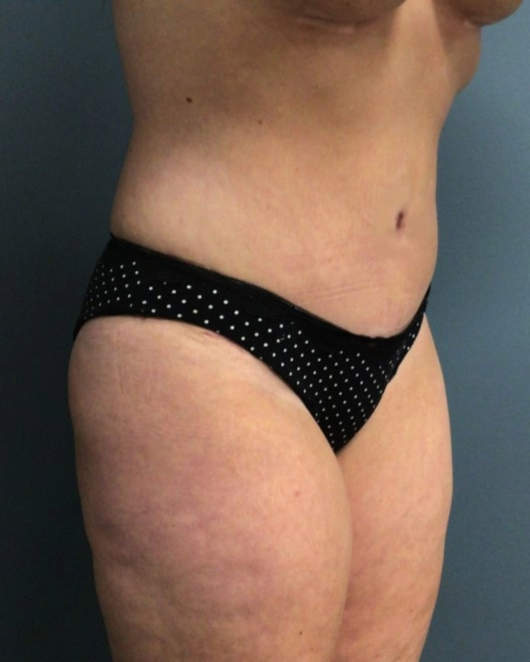 Tummy Tuck Patient Photo - Case 3808 - after view-1