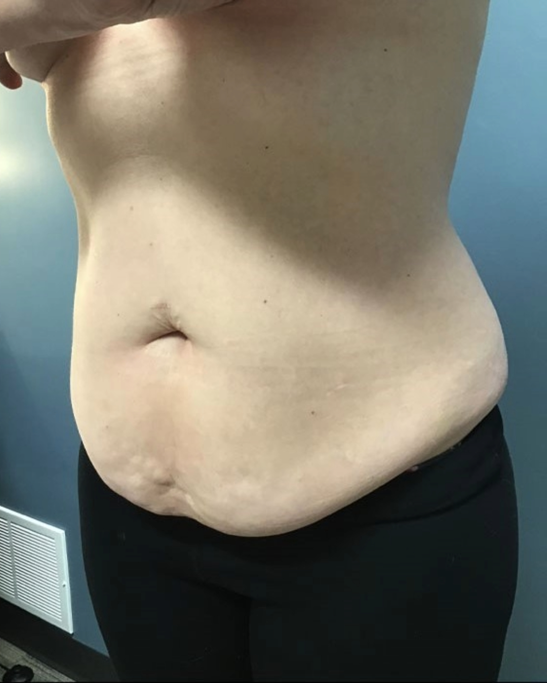 Tummy Tuck Patient Photo - Case 3808 - before view-2