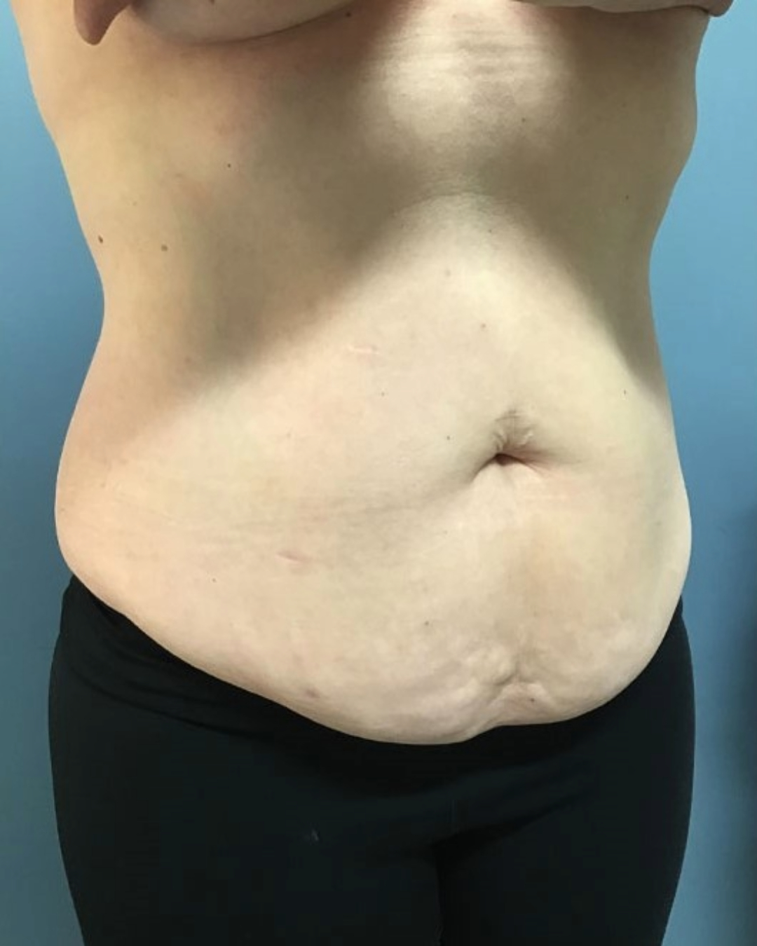 Tummy Tuck Patient Photo - Case 3808 - before view-1