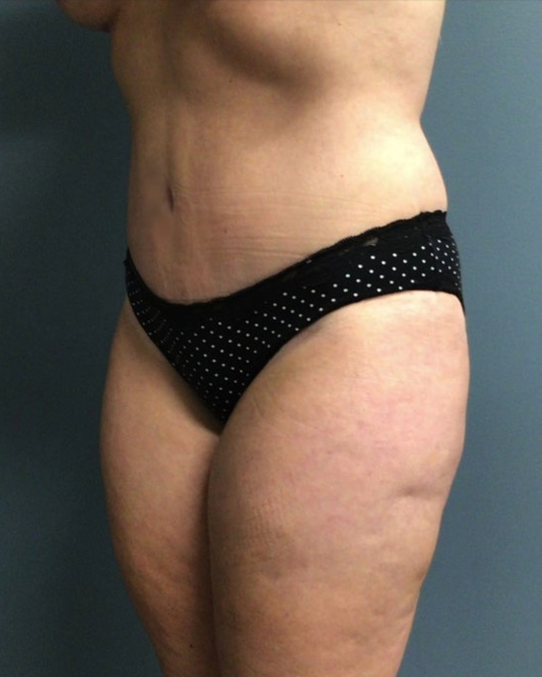 Tummy Tuck Patient Photo - Case 3808 - after view-2